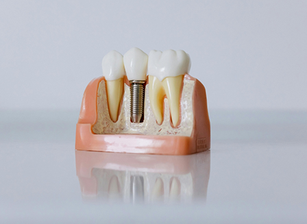 Model of dental implant in Parma on reflective surface